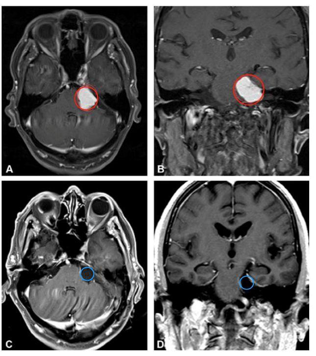 81岁高龄的桥小脑角脑膜瘤老人,全切手术后4天出院,4年未复发