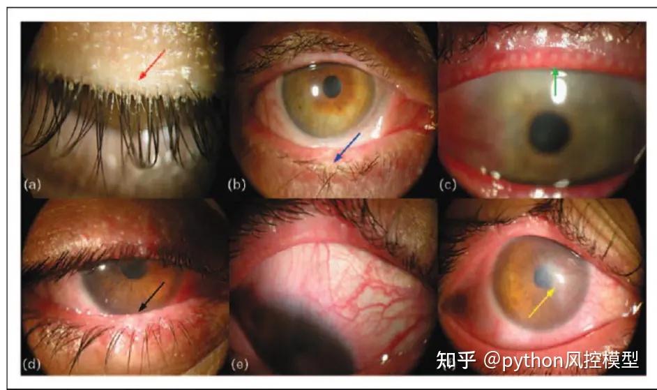 眼睛蠕形螨图片