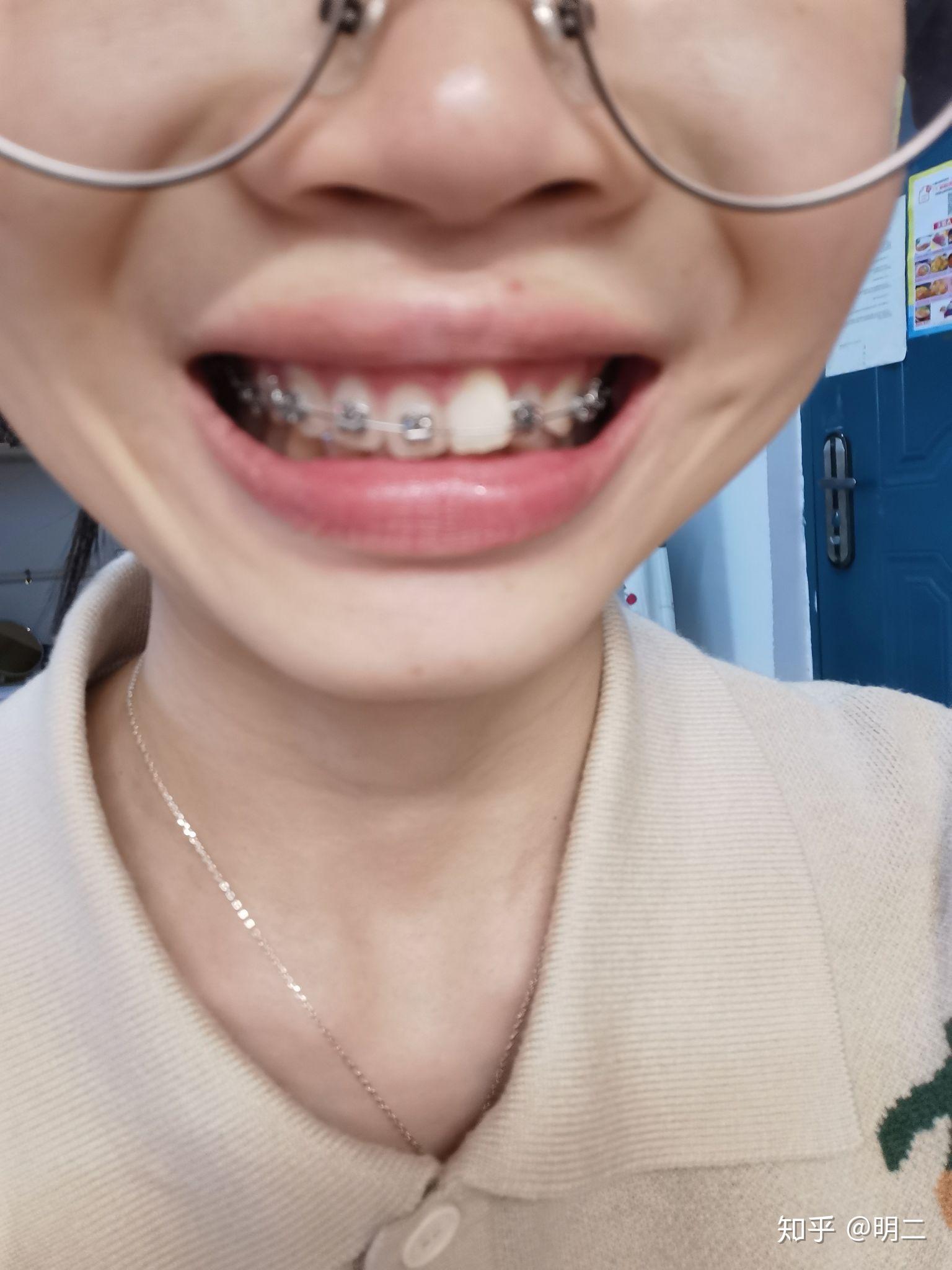戴牙套一般要多久 知乎