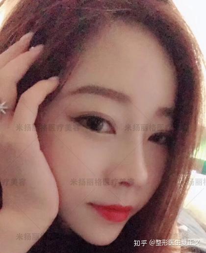 鼻骨骨折手术后鼻子肥大怎么办呢 鼻骨骨折手术需要多久 双偶网 鼻骨骨折手术后鼻子肥大怎么办呢 鼻骨骨折手术需要多久 双偶网
