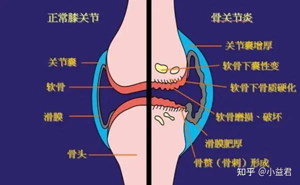 缓解骨关节疼痛可以这么吃