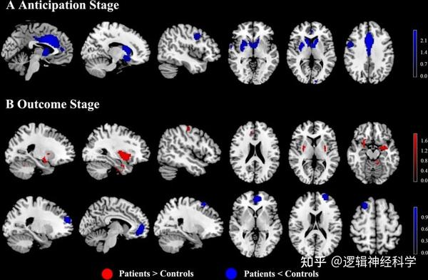 Transl Psychiatry︱重庆大学公共管理学院杨勋团队揭示精神分裂症在奖励预期和奖励结果阶段的不同神经机制 - 知乎