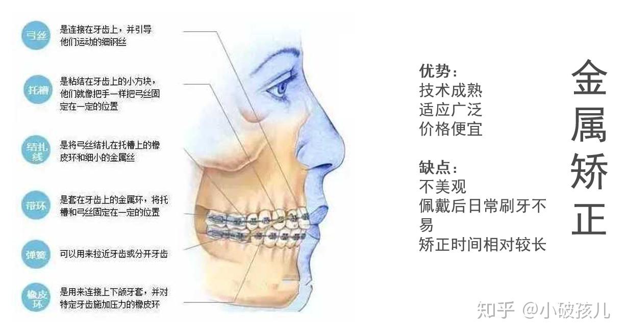 牙齿矫正的详细流程以及矫正器种类的介绍