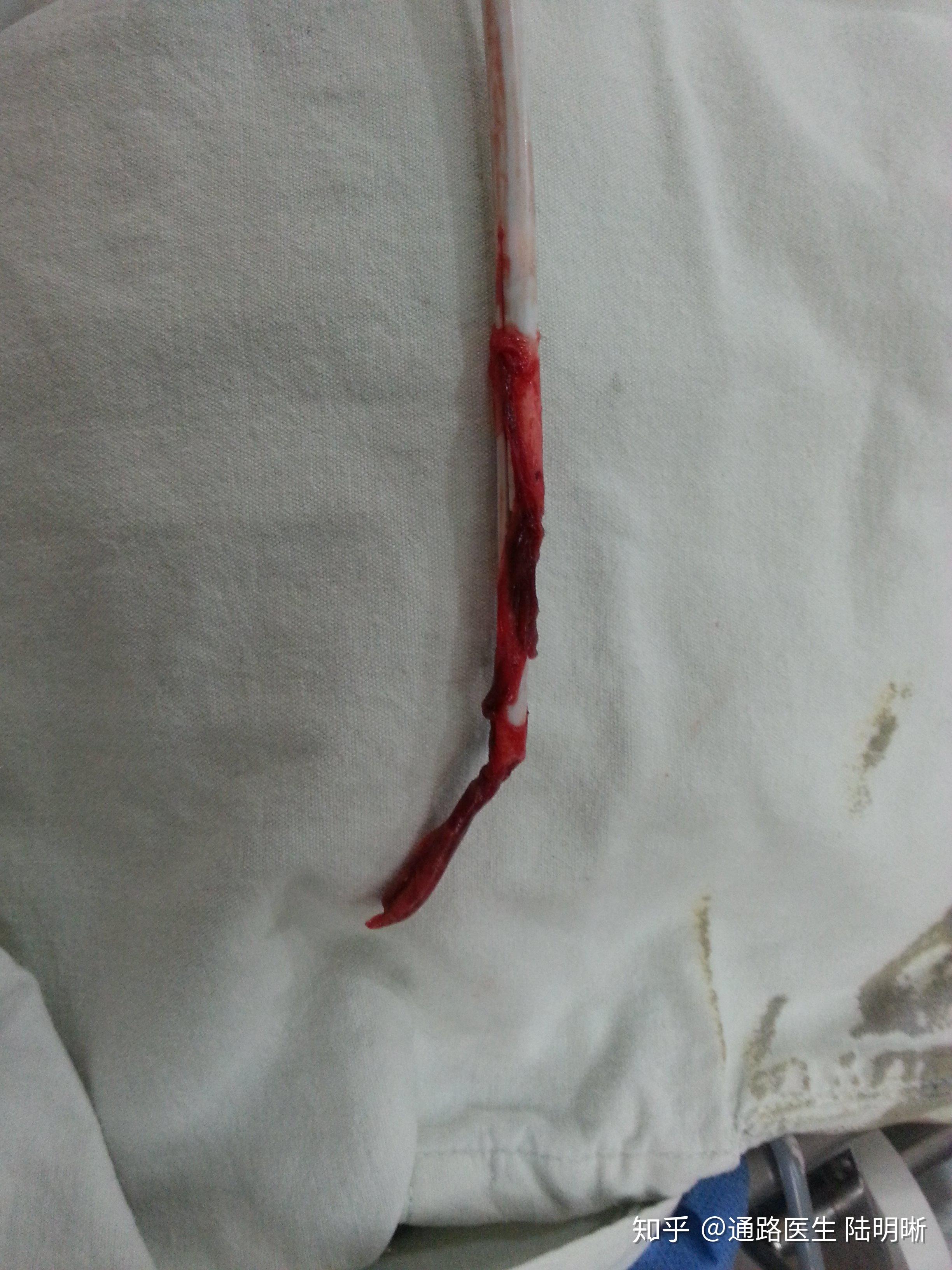 对于导管流量不佳,很多情况下是因为导管周围纤维蛋白鞘形成导管破裂