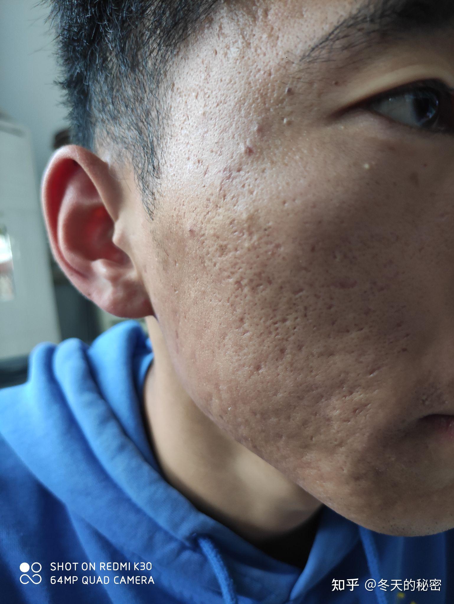 满脸痘坑的人都活得怎么样