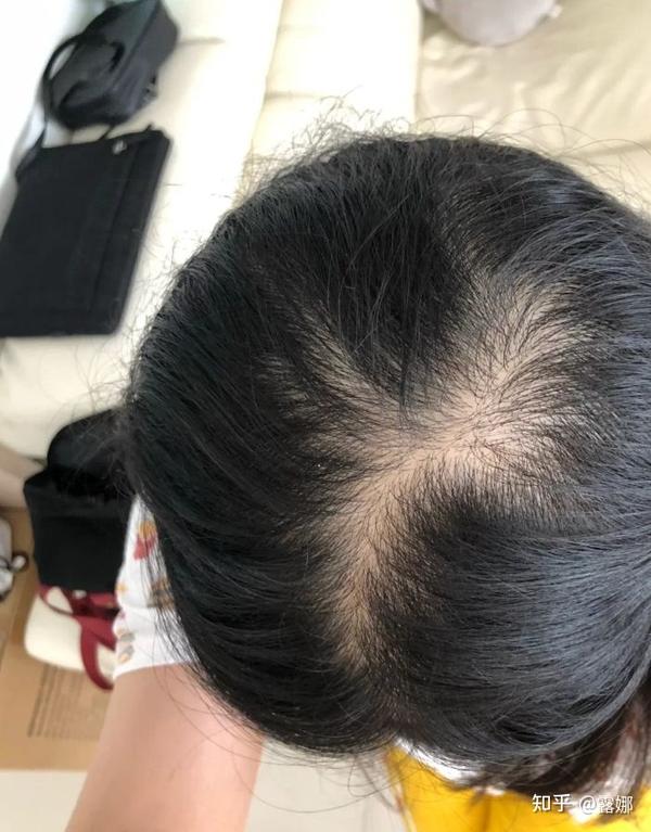 找不到方法你就是秃头界的皇中皇~就像我脱发最严重的时候一样!