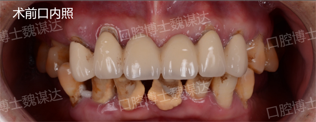 不良修復體伴基牙鬆動,口內多顆牙齒缺失;牙齦萎縮嚴重,全口衛生狀況