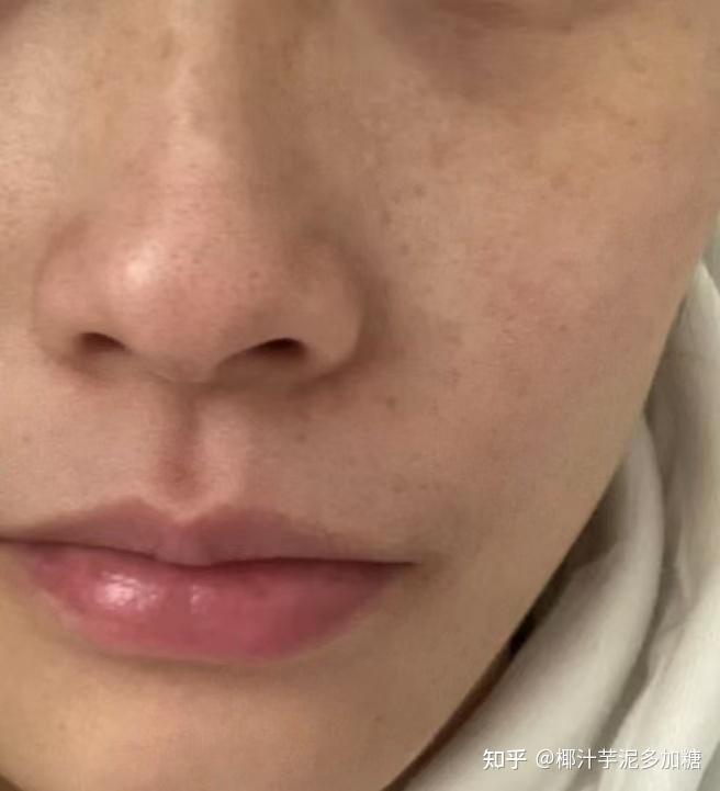 做完医美反黑怎么办?有哪些可以用的精华液?