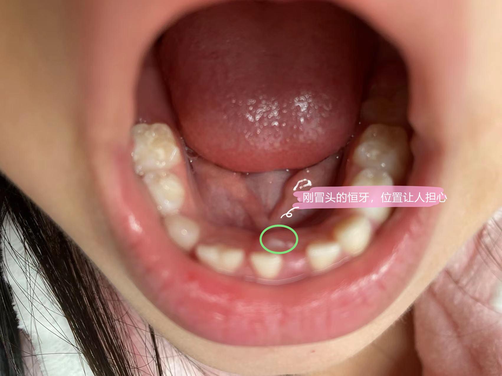 小孩换牙期牙齿要松了老不掉应该拔吗