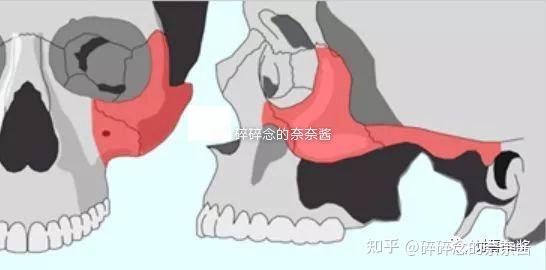 面部轮廓篇——颧骨颧弓手术,接下来一起走进科学…… - 知乎