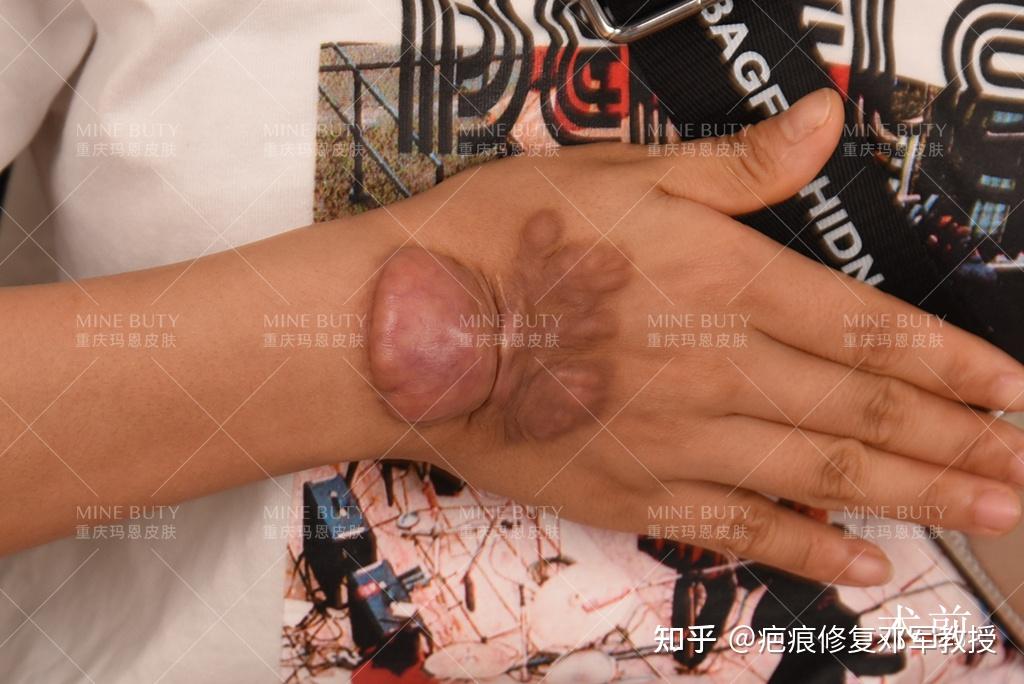 疤痕疙瘩在中医上为什么被称为"蟹足肿"?