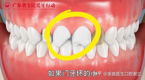中家医家庭医生口腔-门牙缺失怎么办呢 - 知乎