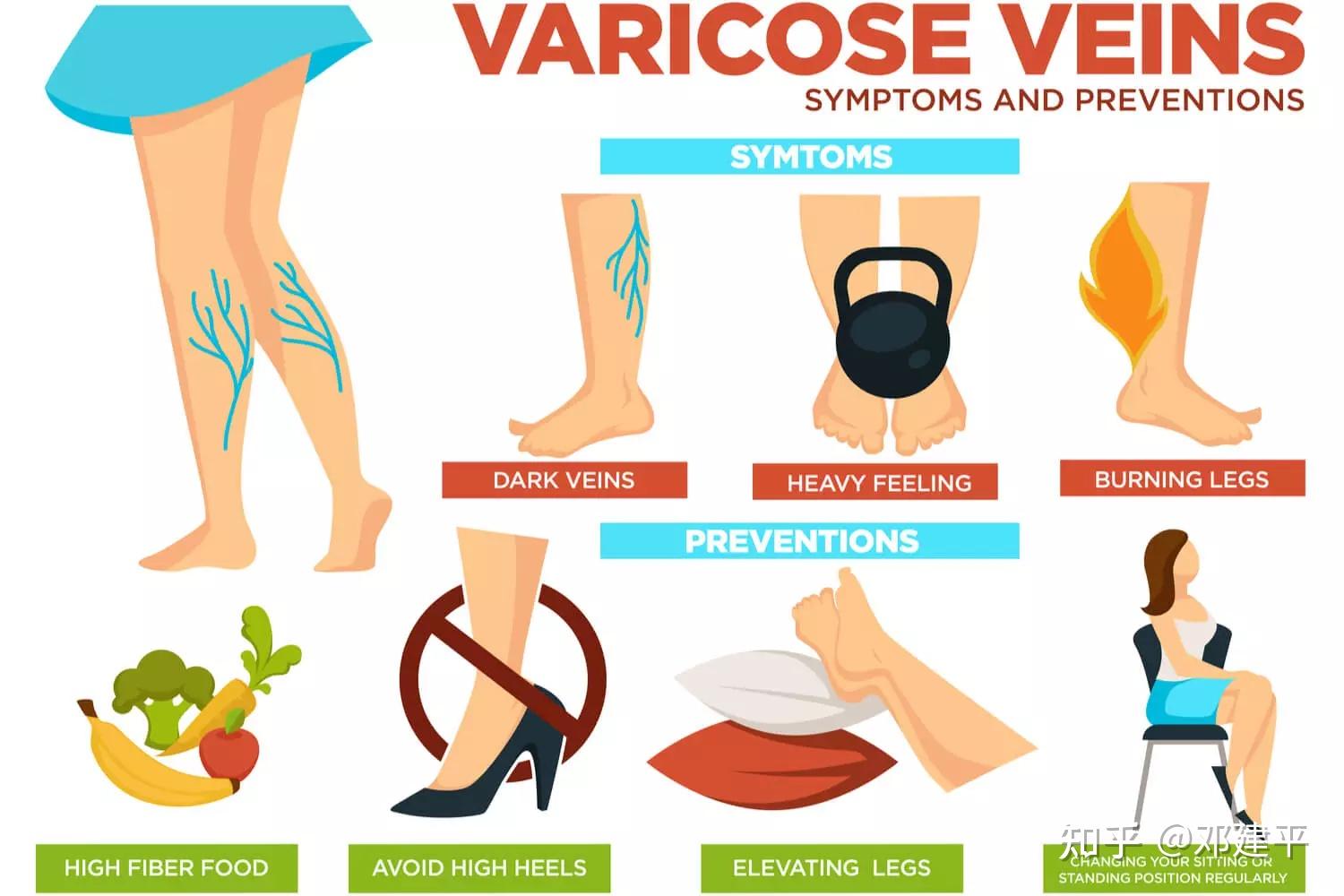 How Do You Get Varicose Veins?
