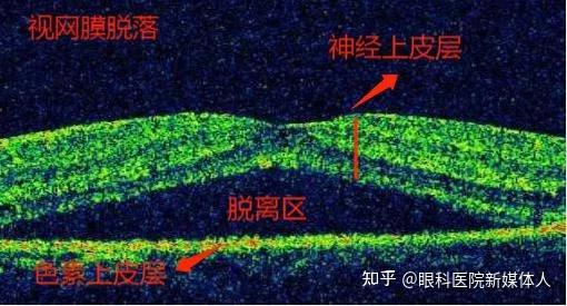 视网膜脱落看到的世界图片