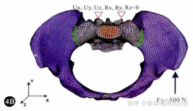 骨盆後環微創螺釘的釘道設計及骨盆三維有限元分析