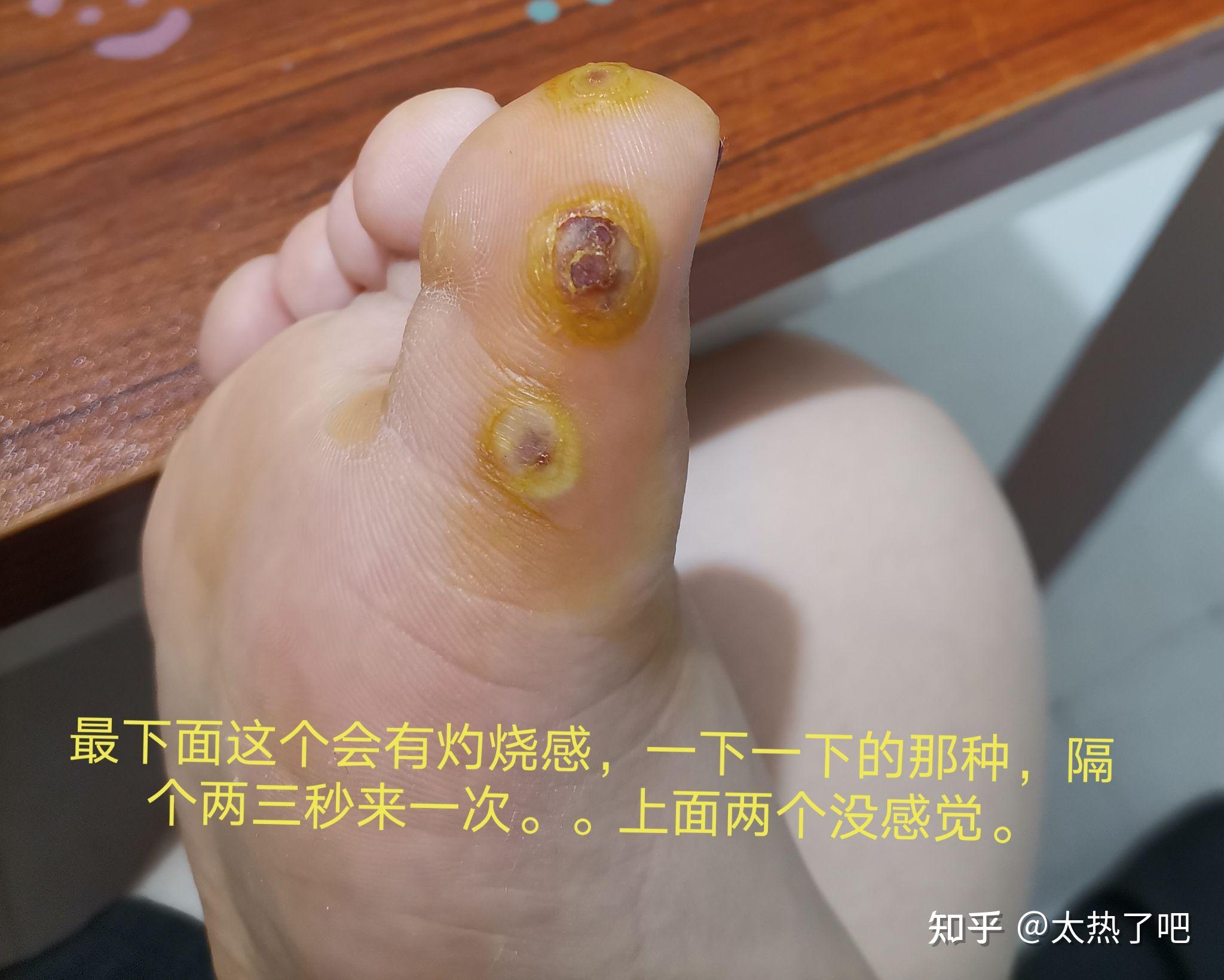 蹠疣和雞眼有什麼區別醫學上有沒有什麼治療蹠疣的好辦法