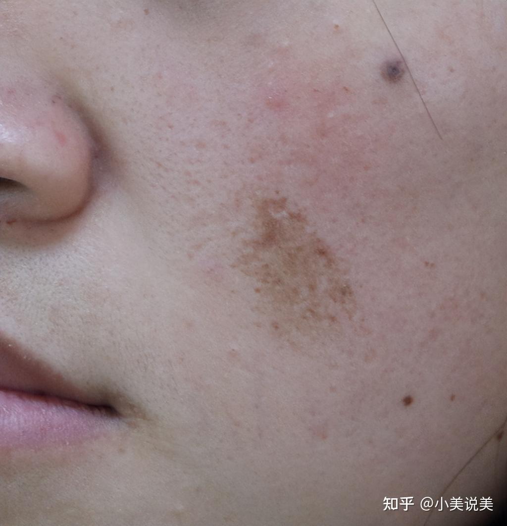 色斑怎么治?先知道你是什么斑