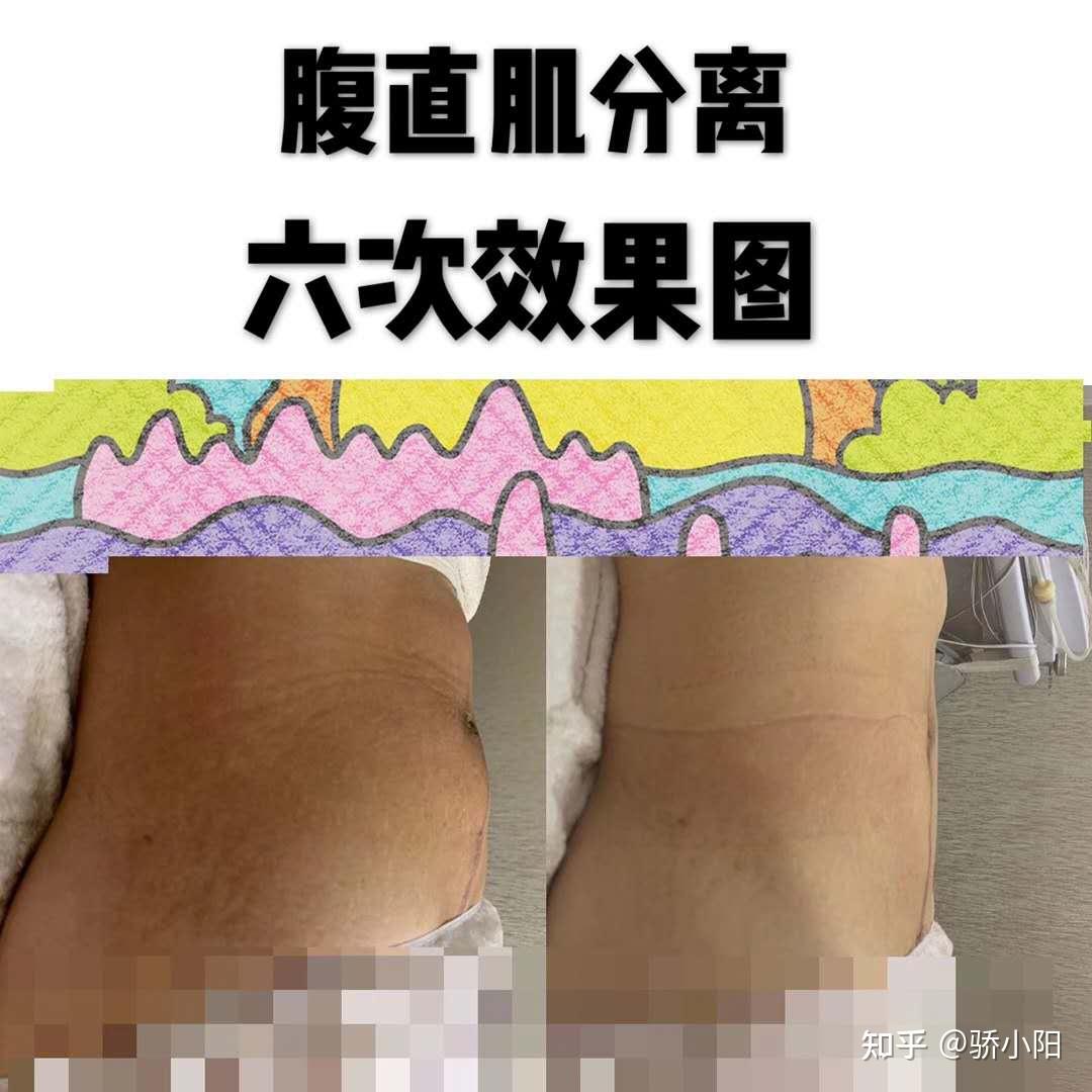 生完寶寶肚子裡還有一個產後大肚子肚皮鬆垮瘦不回去多半是因為它