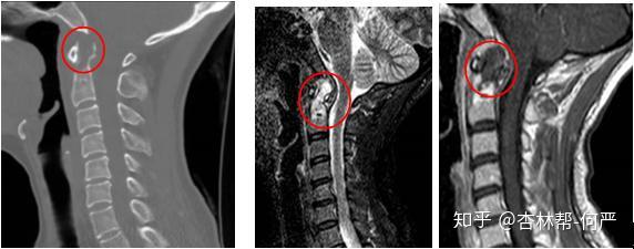 骨肿瘤转移到上颈椎 还能手术吗 挑战脊柱肿瘤的珠穆朗玛峰 知乎