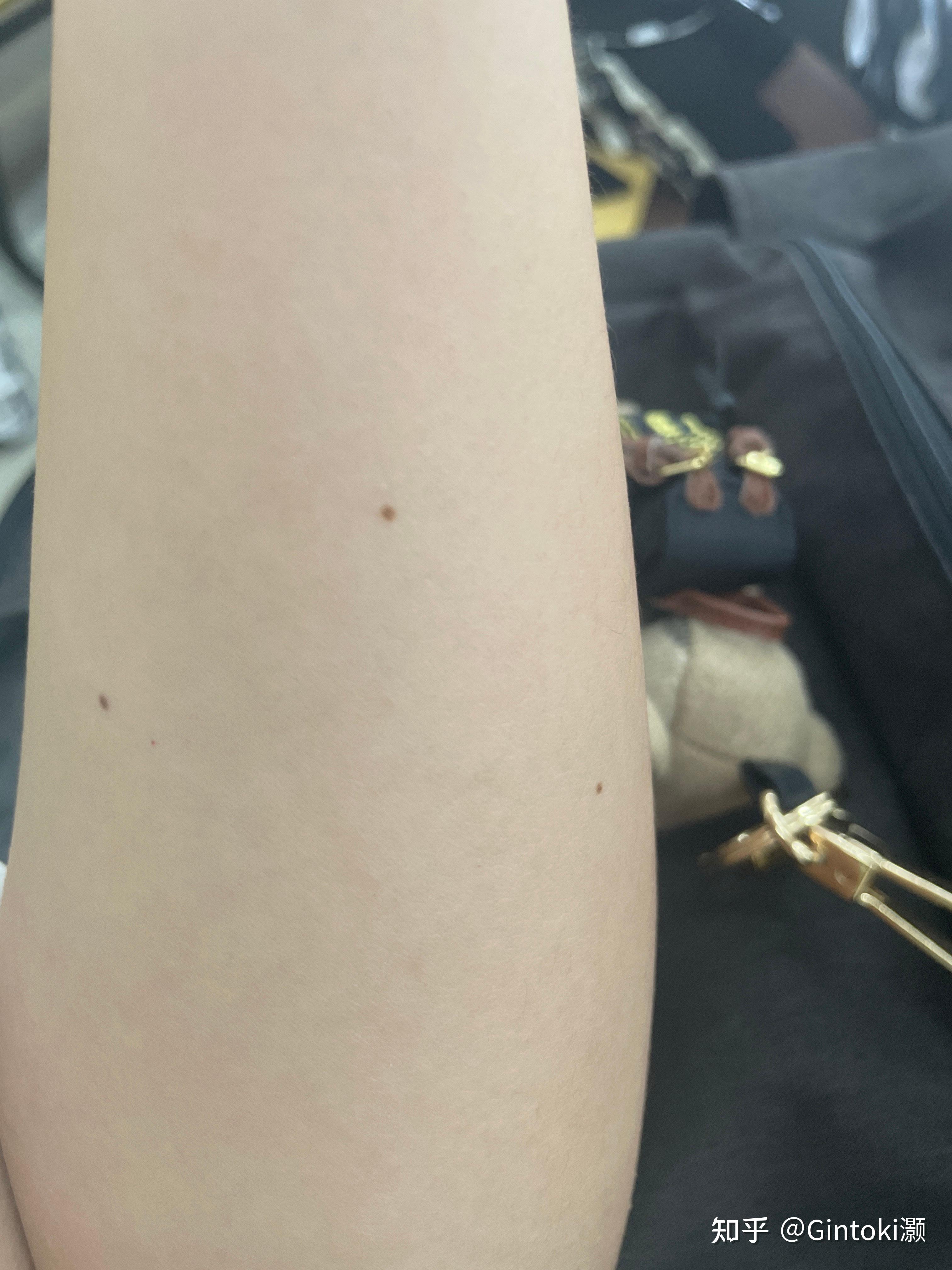 左臂上有三颗痣呈正三角形分布有什么含义