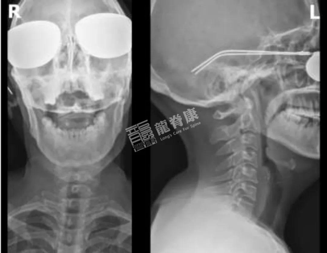 耳朵里会引起的眩晕的耳石症-青海大学附属医院