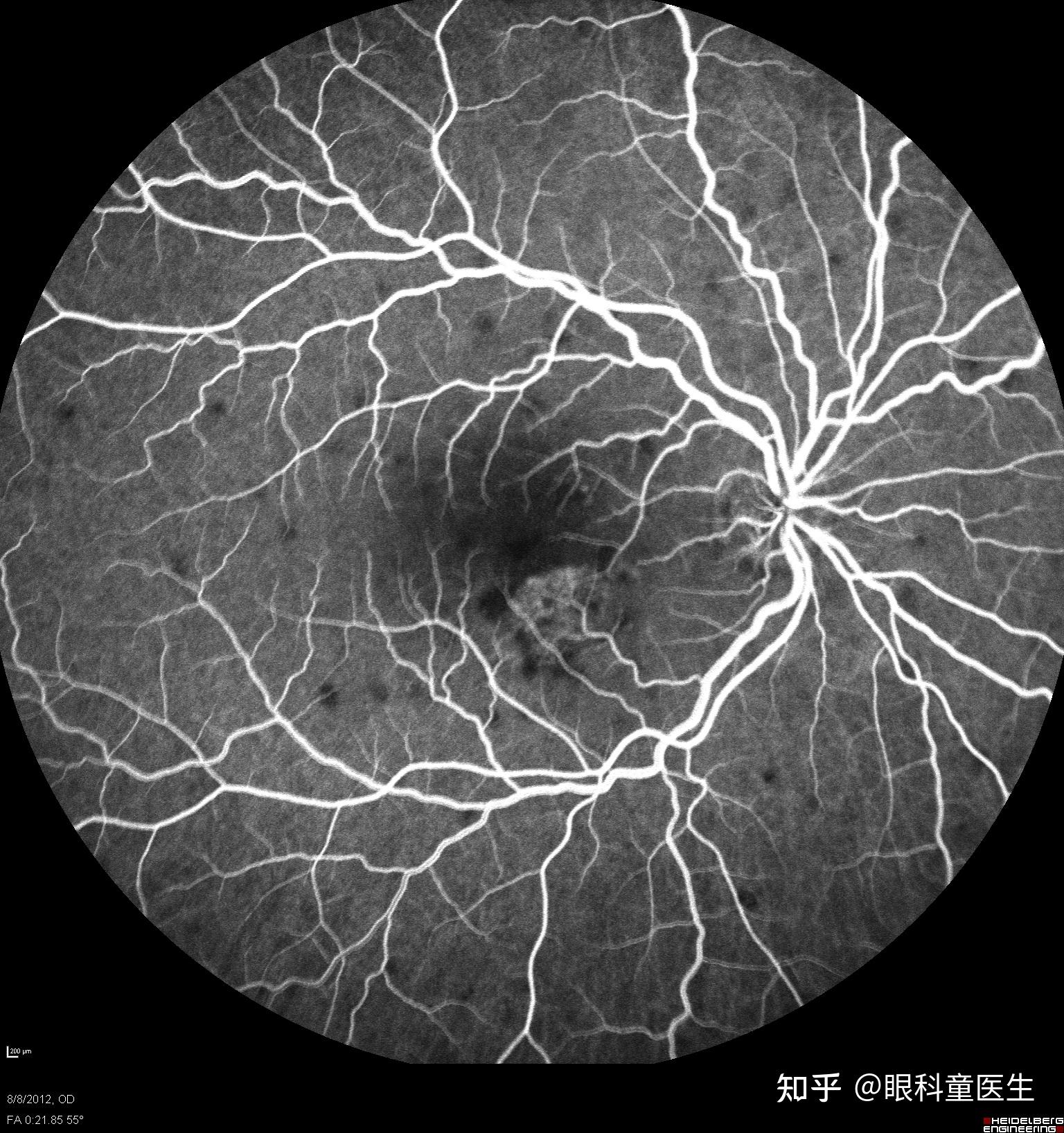 脉络膜透见图片