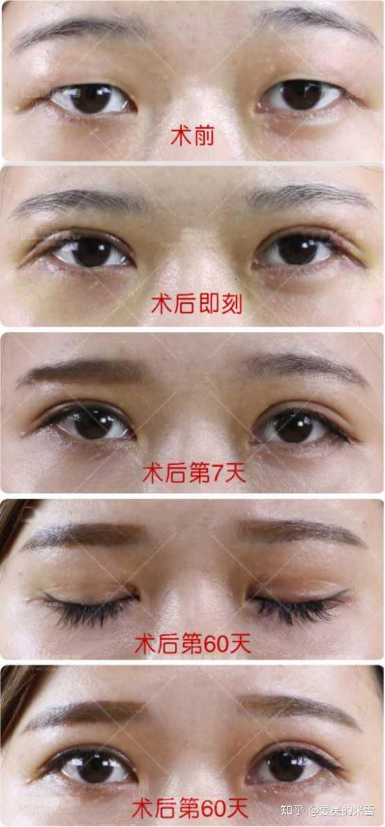 怎么在网上预约双眼皮手术 v2-934e3692c48dbb3a7559c79ecc909219_r.jpg