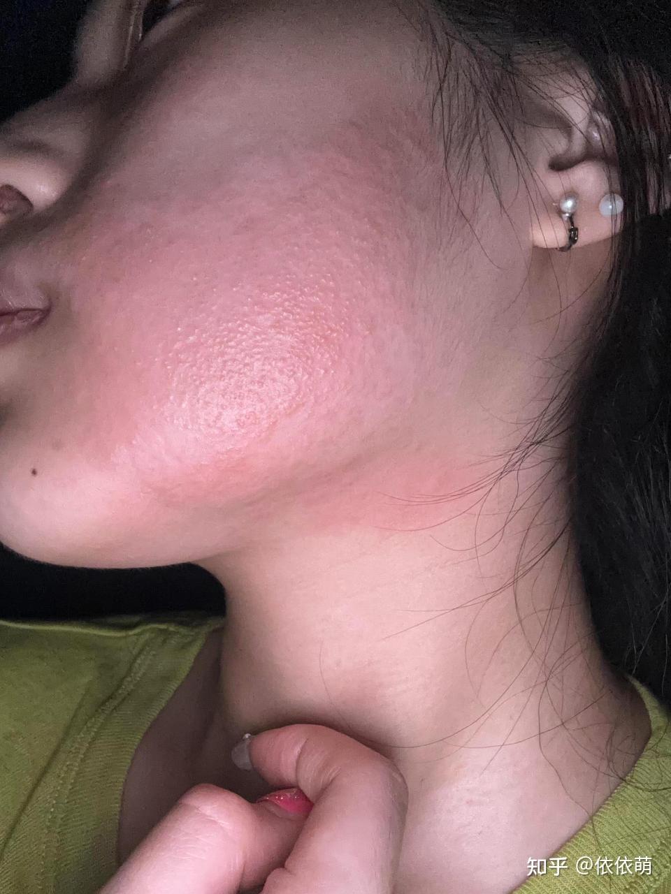 脸上长了湿疹怎么做才不会留黑印?