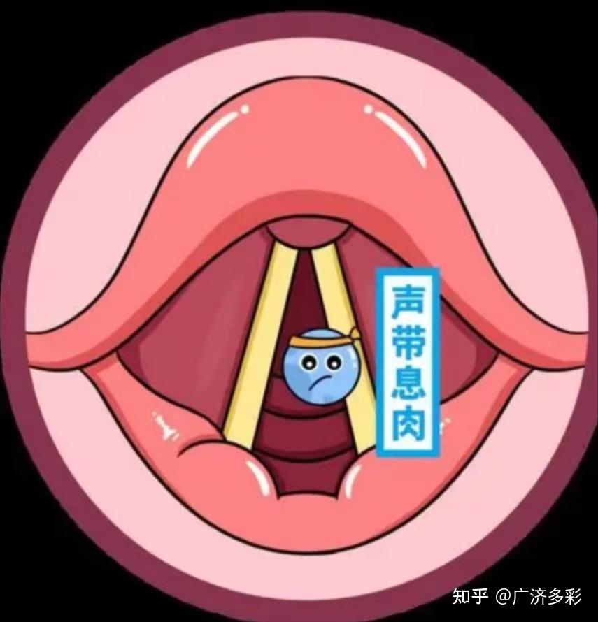 声带长了个小息肉,不想动手术它能自己好吗? - 知乎