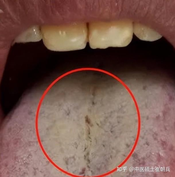 今日舌诊—实战分析—男性朋友，湿热下注，肝火旺 - 知乎