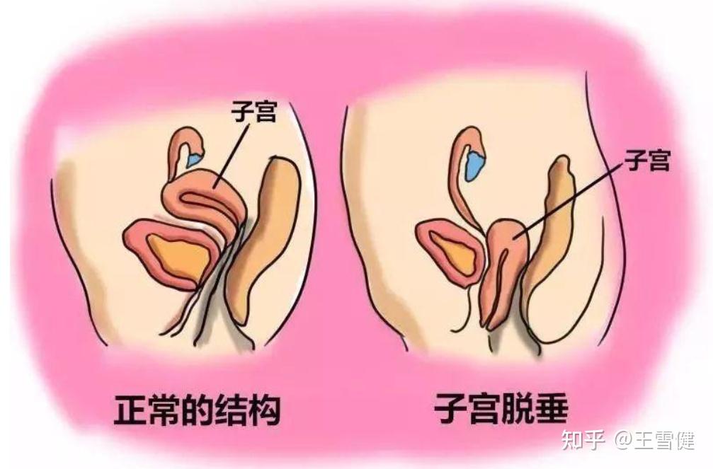 如何防止自己出现子宫脱垂