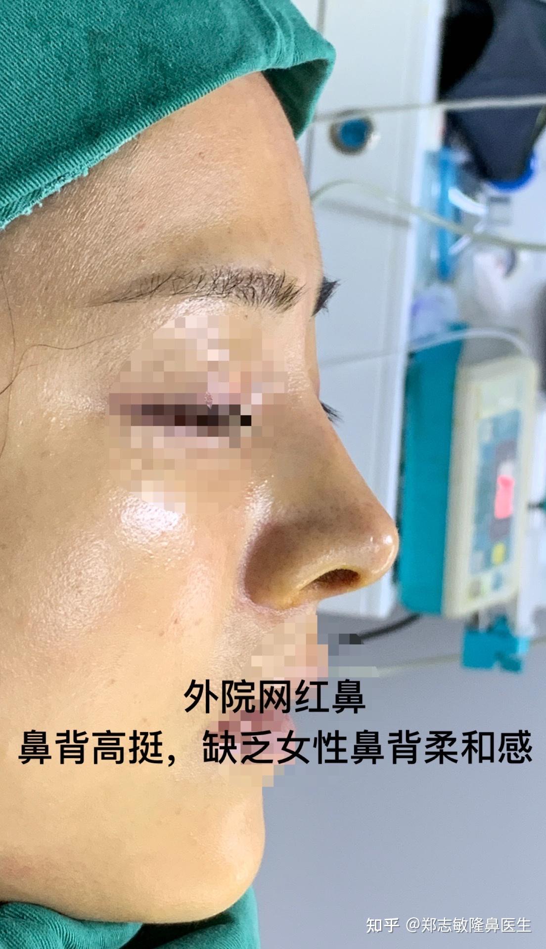 鼻背(鼻梁)高挺的网红鼻,真的好看吗? - 知乎