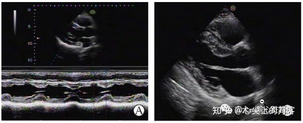 心脏移植的超声心动图评估 - 知乎
