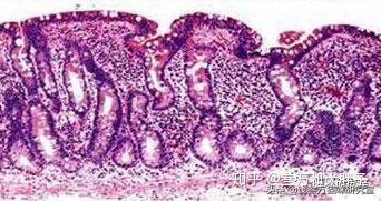 炎症性肠病IBD】猫吐毛球的本质原因是什么? - 知乎