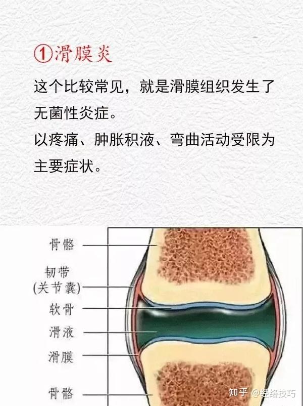 如何分辨滑膜炎 骨膜炎 滑囊炎 腱鞘炎 筋膜炎 知乎