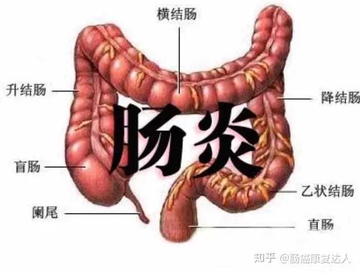 直肠癌患者术后吻合口炎,放射性直肠炎,各种肛肠炎症导致的疼痛性大便