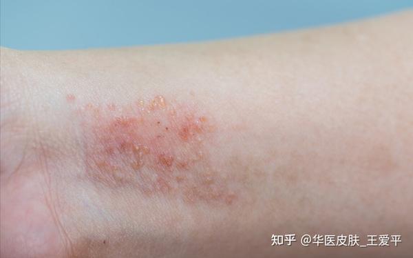 脂溢性皮炎治疗方案,内科治疗最重要 - 知乎