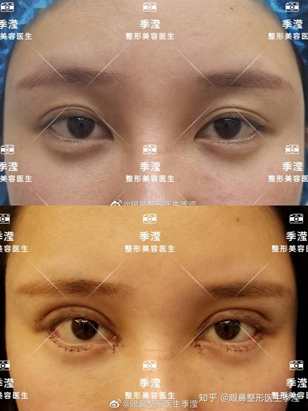 双眼皮开内外眼角下眼睑下至