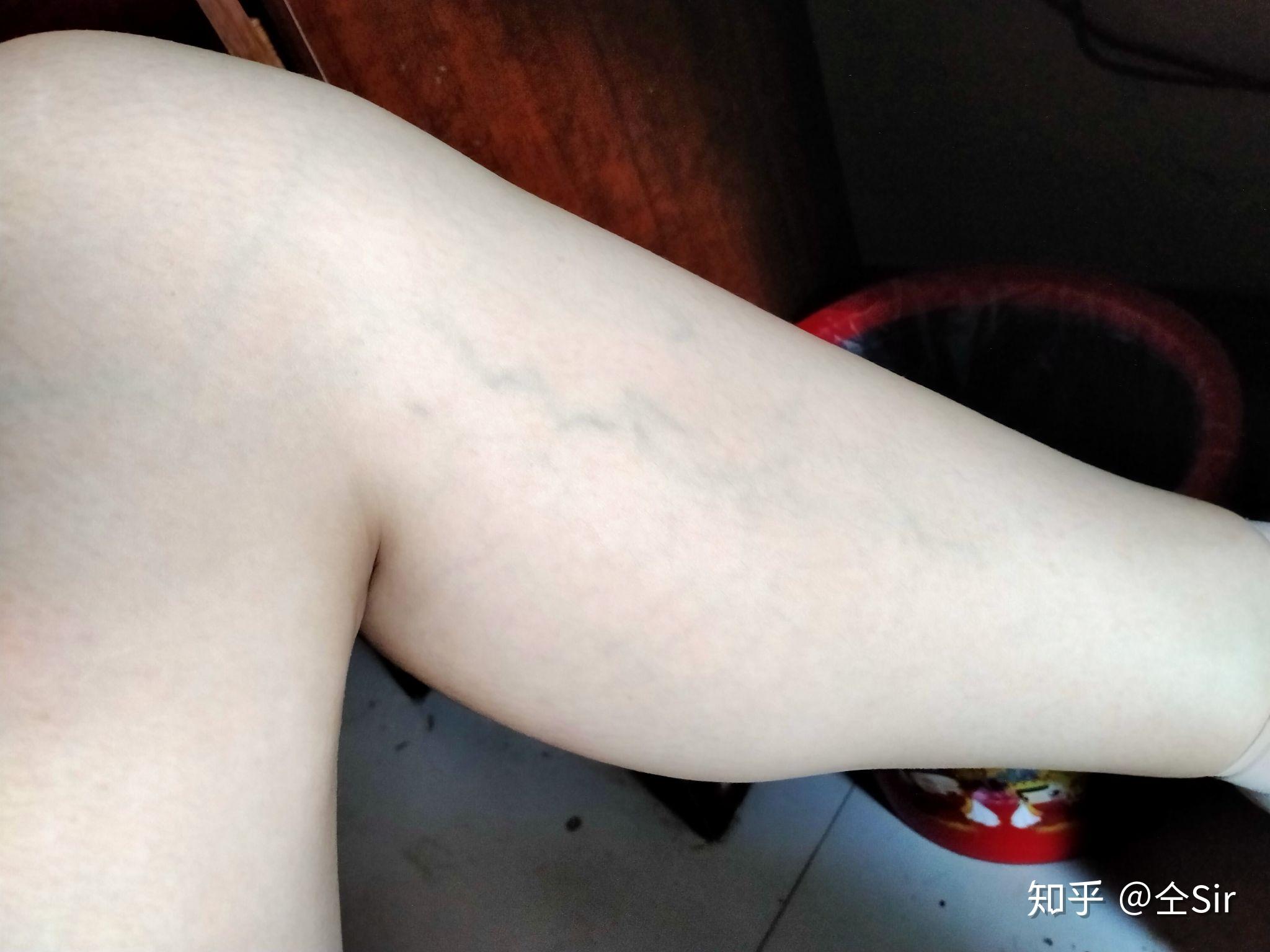 我的小腿肌肉上面膝盖下面有青筋特别明显属于静脉曲张吗可是我才二十
