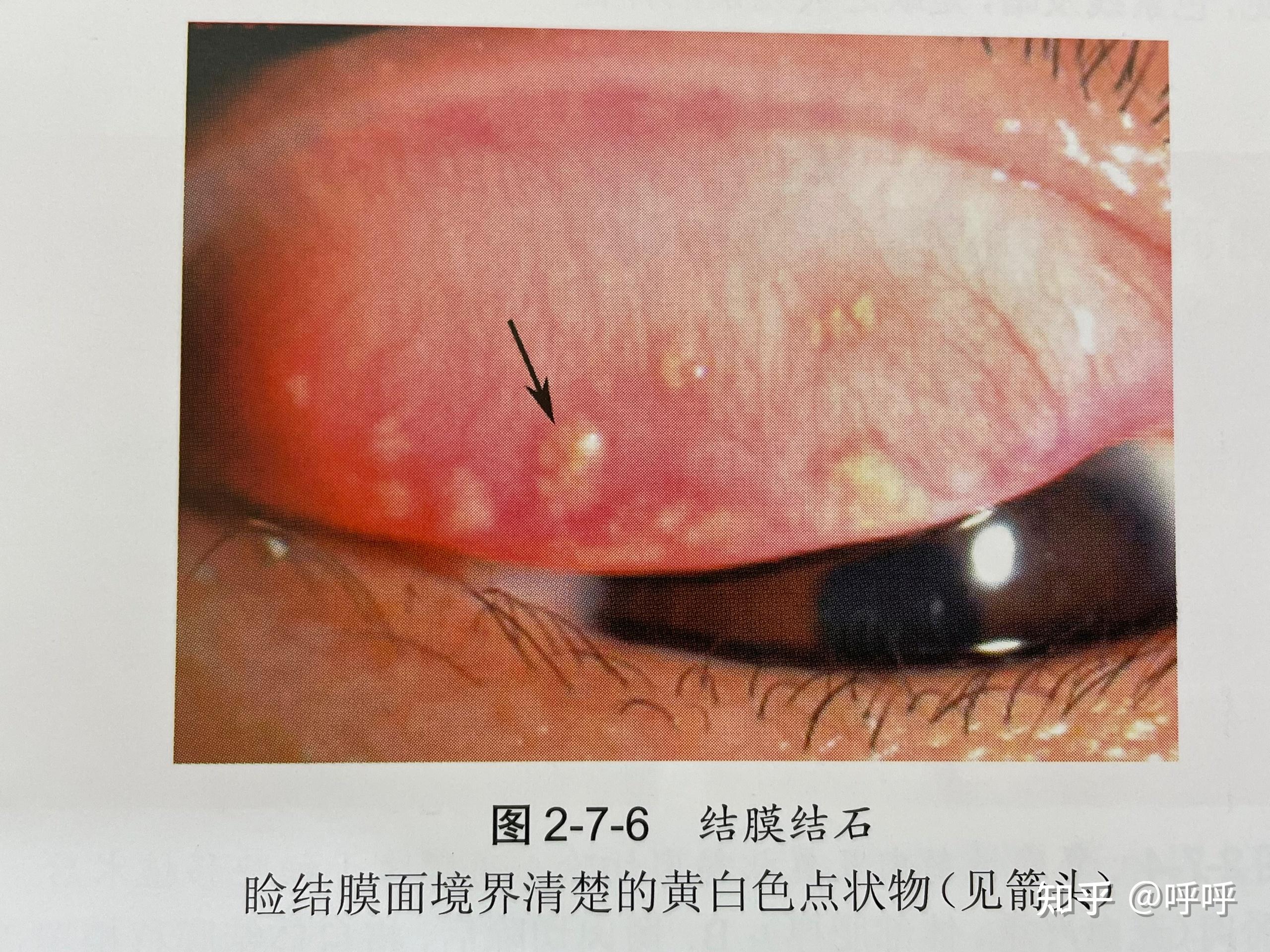 眼结石并不是真正的结石,是眼结膜(即眼睑,眼皮的内侧面)上出现的颗粒