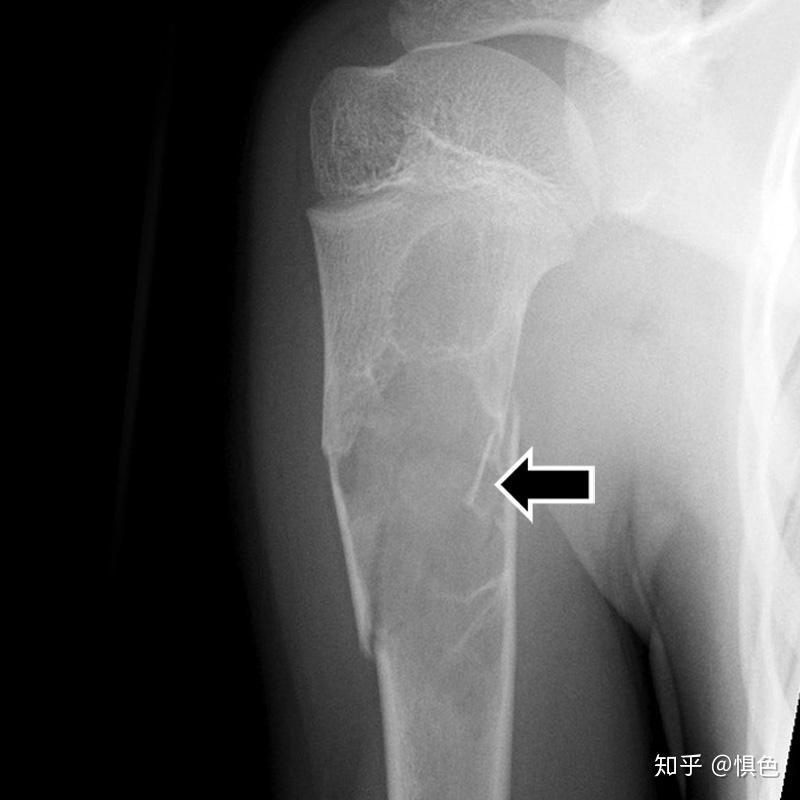 骨囊肿 Bone Cyst 知乎 1403