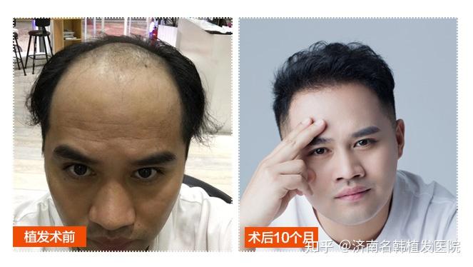 植发亲身经历-明星御用植发师妙谈“脱发大叔变男模”背后植发技巧 - 知乎