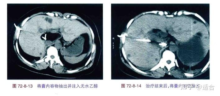 從非凡醫者淺談肝囊腫治療