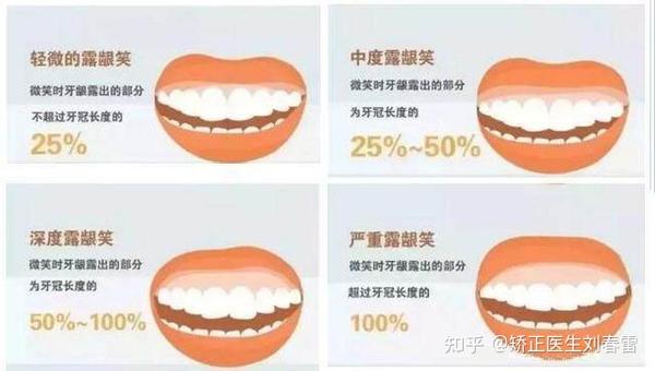 3招教您如何改善露龈笑?露龈笑再见!【内附真人案例】 - 知乎
