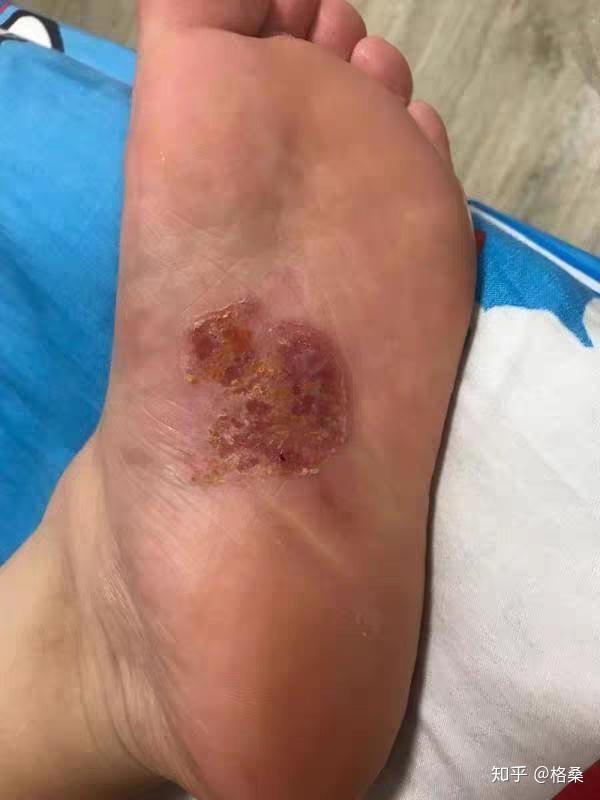 所以前前后后用了3盒才停的药可能我脚气比较顽固而且还溃烂的比较