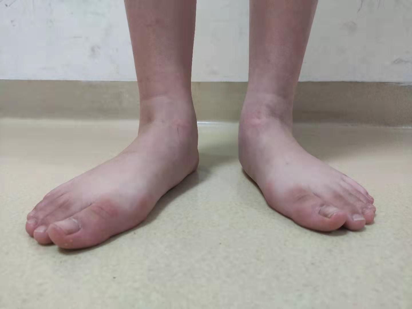 孩子扁平足需要治疗吗看儿童骨科医生专业的解答