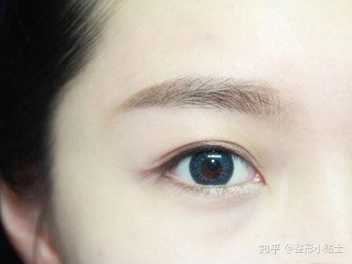 双眼皮割的自然是怎样一种体验 知乎