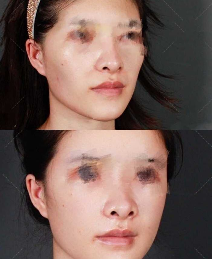 郑州自体脂肪填充哪个医院医生做的比较好喜欢自然风格的填充
