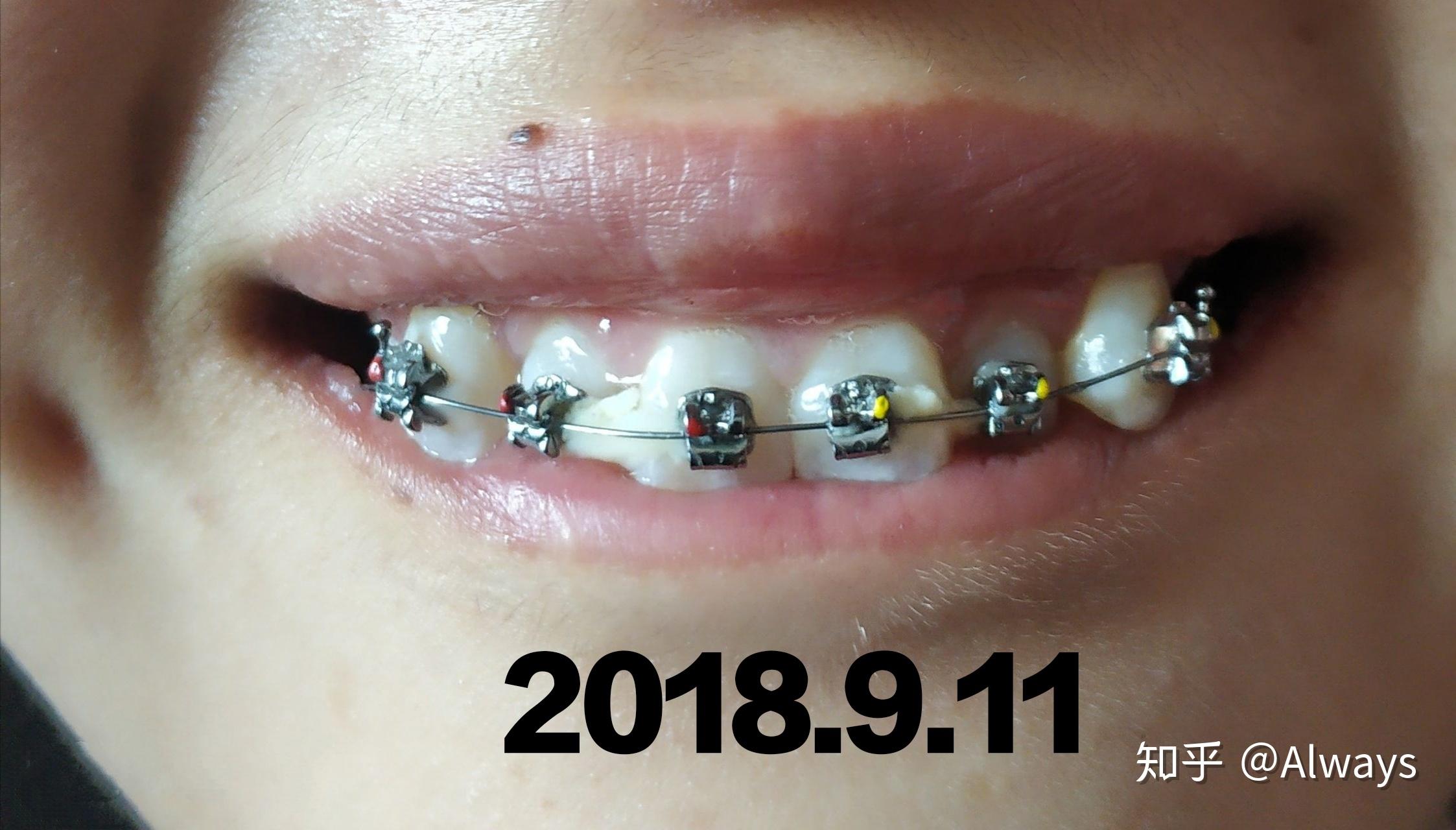 正畸矫正22岁带自锁牙套的全过程