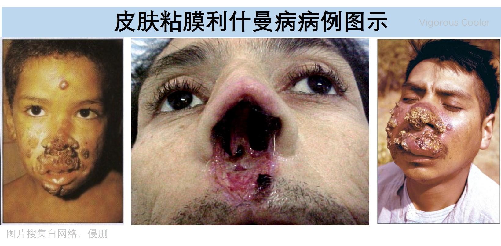 什么叙利亚的食肉虫国内也有利什曼病速览